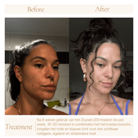 Vrouwen met stralende huid na skincare routine met Zourani LED Face Masker